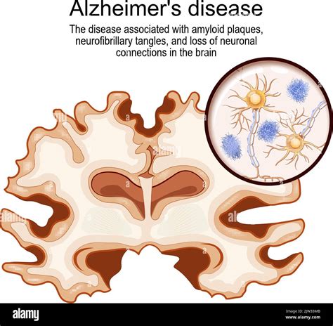 Amyloid plaques .
